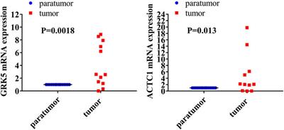 Co-Overexpression of GRK5/ACTC1 Correlates With the Clinical Parameters and Poor Prognosis of Epithelial Ovarian Cancer